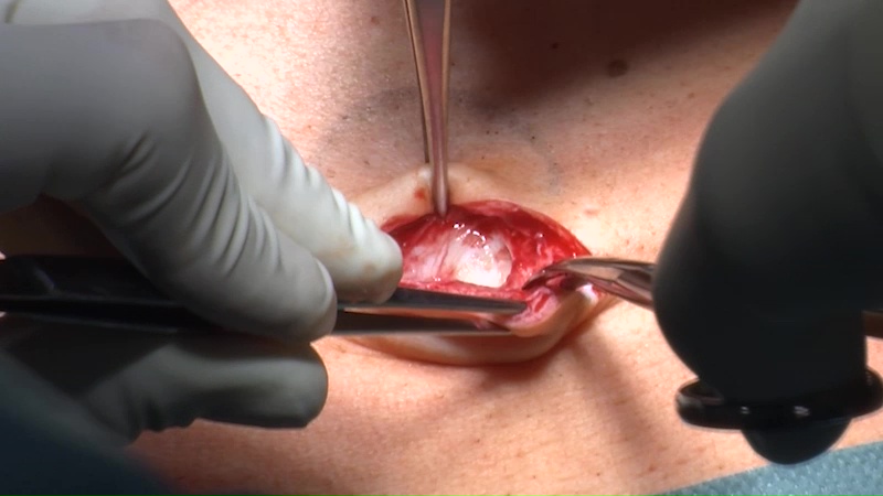 腹壁疝与切口疝微创治疗最佳新技术:milos手术